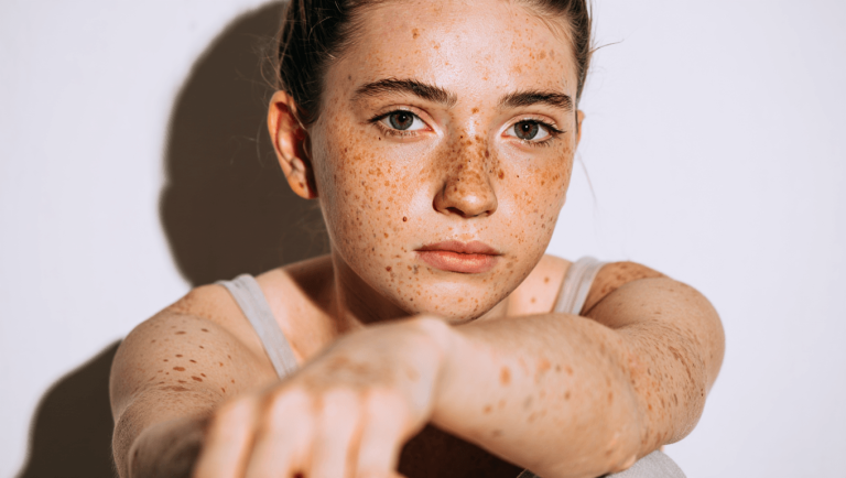 What Your Mole Count Could Reveal About Your Melanoma Risk