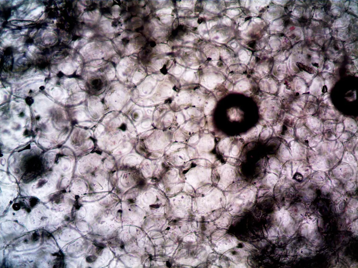 Cellules cancéreuses observées au microscope en laboratoire de recherche