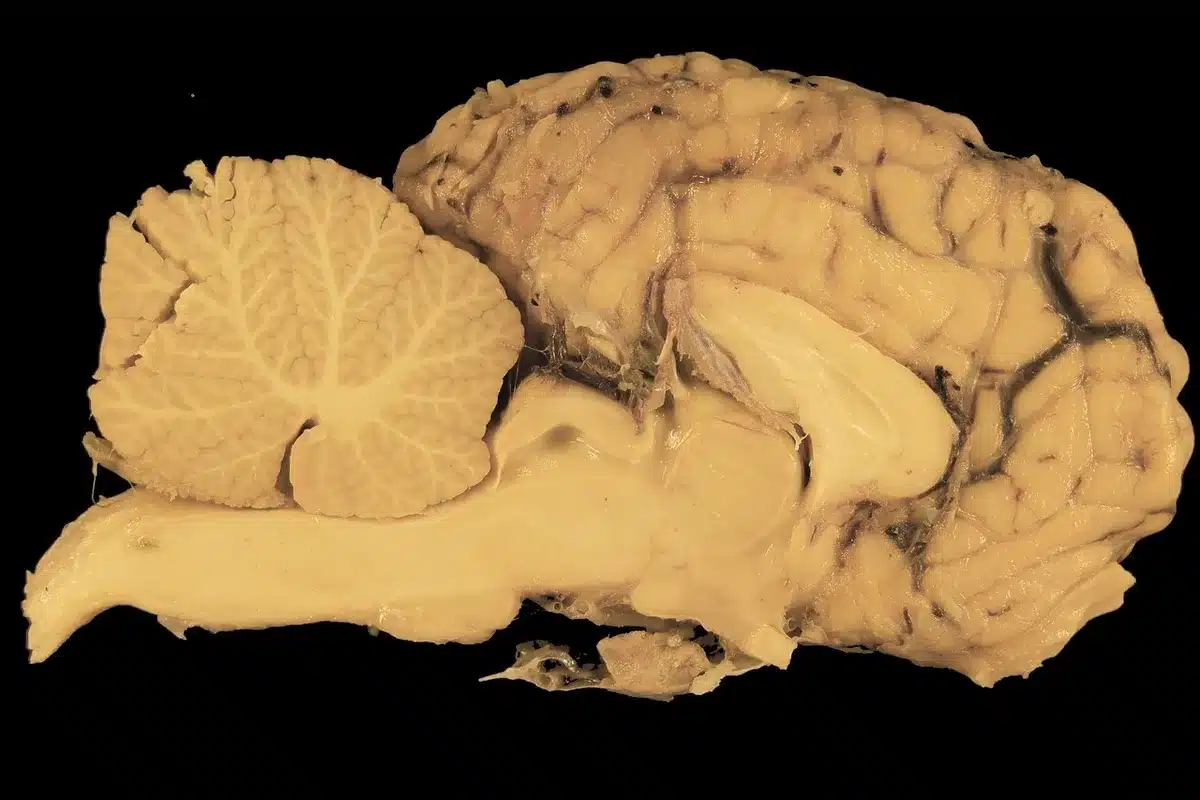 Vue schématique d'une IRM volumétrique montrant le cortex et régions cérébrales